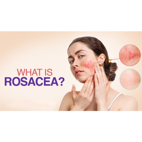 fito.C - 5,2% Rosacea Complex Serum - 5,2% Rozácea Komplex Szérum, 30ml 