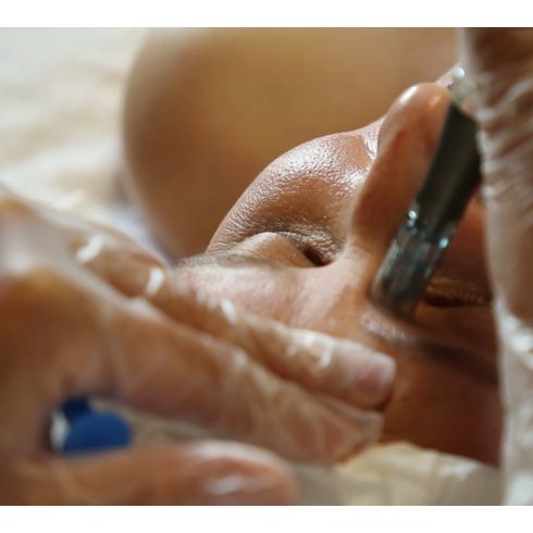 fito.C - Tűs Mezo Kezelés, 20 perc - INGYENES