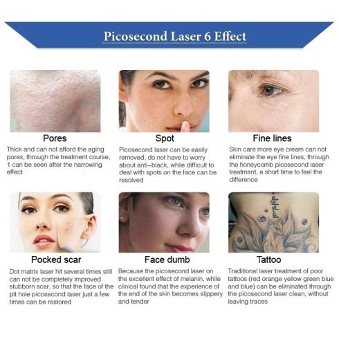 ND YAG PICOSECOND LÉZER - br. 1099eFt - CARBON PEELING - TETOVÁLÁS ELTÁVOLÍTÁS - PIGMENT FOLT HALVÁNYÍTÁS - RENDELÉSRE