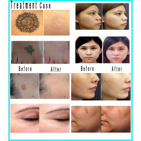 ND YAG PICOSECOND LÉZER - br. 1099eFt - CARBON PEELING - TETOVÁLÁS ELTÁVOLÍTÁS - PIGMENT FOLT HALVÁNYÍTÁS - RENDELÉSRE